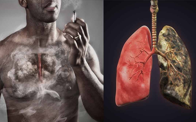 Ung thư phổi: Không hút thuốc vẫn có nguy cơ Ung thư phổi: Không hút thuốc vẫn có nguy cơ