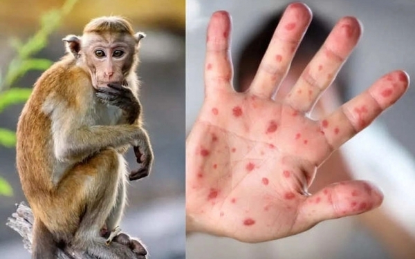 Tỉnh Đắk Lắk: Phát hiện một trường hợp trở về từ Nam Phi nghi mắc đậu mùa khỉ